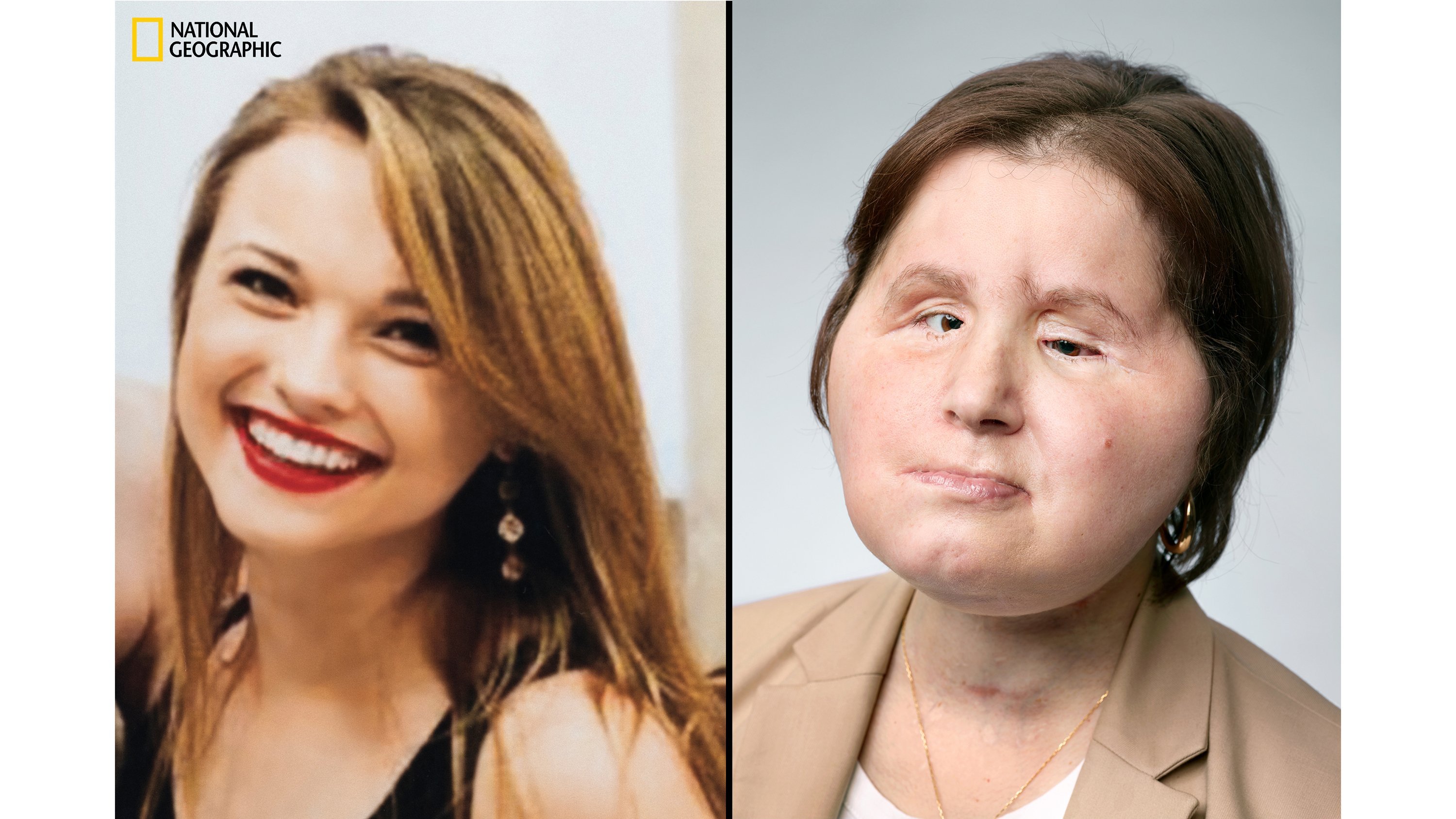 The Remarkable Saga of a Young Woman's Face Transplant